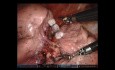 Lobectomía superior izquierda robótica sin editar para tratar tumores primarios pulmonares bilaterales sincrónicos