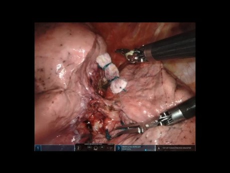 Lobectomía superior izquierda robótica sin editar para tratar tumores primarios pulmonares bilaterales sincrónicos