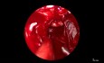 Abordaje endoscópico transnasal para la resección de microadenoma hipofisario en pacientes con acromegalia