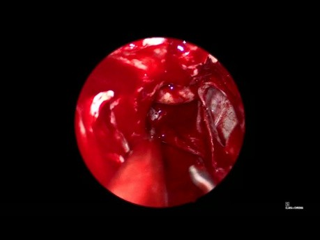 Abordaje endoscópico transnasal para la resección de microadenoma hipofisario en pacientes con acromegalia
