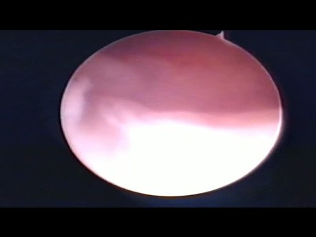 Cuerno uterino rudimentario 16 años, año 2001