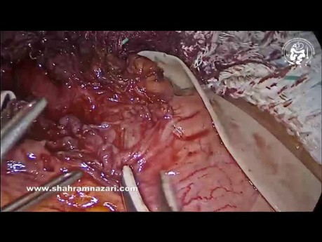 Miotomía laparoscópica de Heller y fundoplicatura Dor