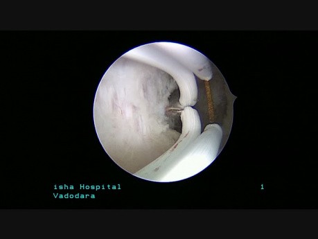 Septum completo vaginal, intracervical e intrauterino