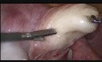 Miomectomía laparoscópica en caso de fibroma de la pared posterior