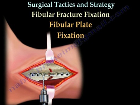 Fracturas de tobillo y su reparación - video-clase