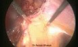 Reparación laparoscópica de hernia incisional