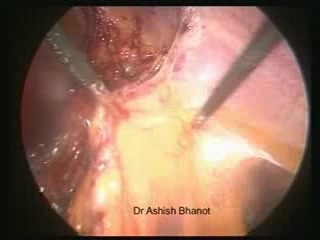 Reparación laparoscópica de hernia incisional