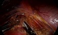 Lesión del tronco celíaco durante el tratamiento laparoscópico del síndrome del ligamento arcuato medio (Mals, Dunbar)