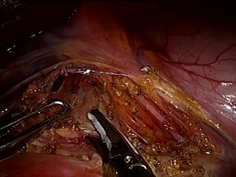 Lesión del tronco celíaco durante el tratamiento laparoscópico del síndrome del ligamento arcuato medio (Mals, Dunbar)