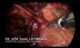Reparación de Hernia Inguinal Recurrente por Laparoscopia. TAPP Derecho.