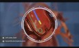 Animación médica 3D: Implementación de una válvula cardíaca artificial