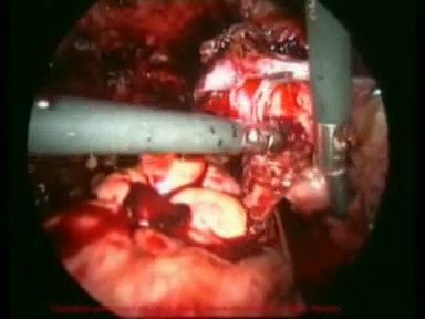 Cirugía de endometriosis - método laparoscópico