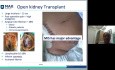 Trasplante renal robótico con los Dres. Kumar y Kishore - Seminario web