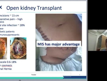 Trasplante renal robótico con los Dres. Kumar y Kishore - Seminario web