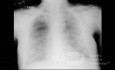 Radiografía de tórax - COVID-19 (4)