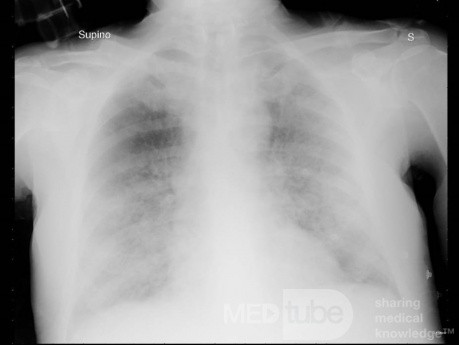 Radiografía de tórax - COVID-19 (4)