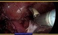 Histerectomía laparoscópica total con ooferectomía salpingo bilateral con adhesiolisis extensa