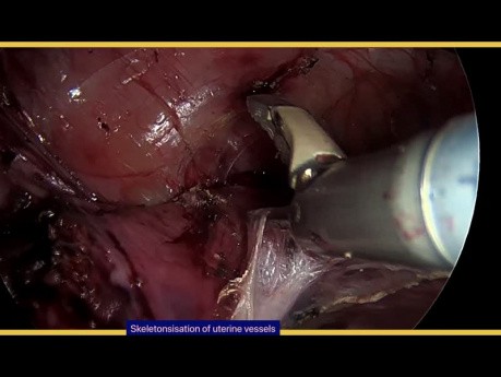 Histerectomía laparoscópica total con ooferectomía salpingo bilateral con adhesiolisis extensa