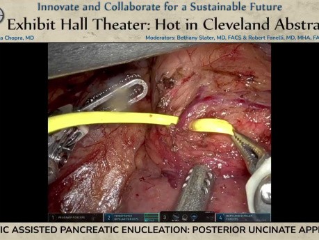 Enucleación pancreática asistida por robot mediante abordaje uncinado posterior