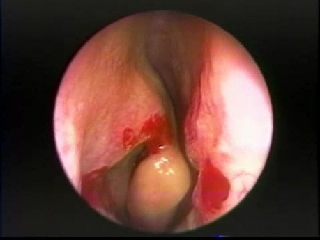 Proceso uncinado doblado anteriormente - endoscopia