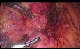 Extirpación laparoscópica de feocromocitoma extraadrenal (paraganglioma)