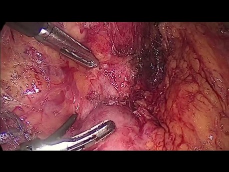 Extirpación laparoscópica de feocromocitoma extraadrenal (paraganglioma)