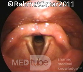 Entrada a la laringe