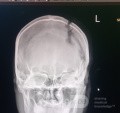 Craniectomía descompresiva en infarto maligno de la arteria cerebral media