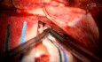 Aplicación pterional derecha para resección de meningioma del surco olfatorio