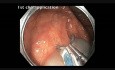 Colonoscopia - resección de lesión plana en colon ascendente