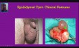Inflamación Escrotal - Espermatocele