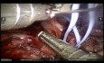 Adenocarcinoma de pulmón que invade la cisura