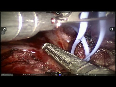 Adenocarcinoma de pulmón que invade la cisura