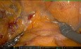 Reparación robótica de hernia inguinal bilateral mediante R-TAPP