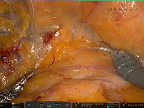 Reparación robótica de hernia inguinal bilateral mediante R-TAPP