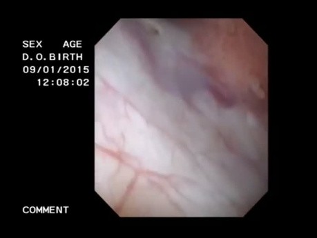 Neoformación vesical en el meato ureteral izquierdo