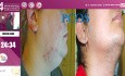 Metformina, propranolol y ácido tranexámico en dermatología