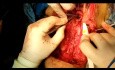 Exploración extensiva simultánea de cuello y mediastino por afectación tumoral invasiva