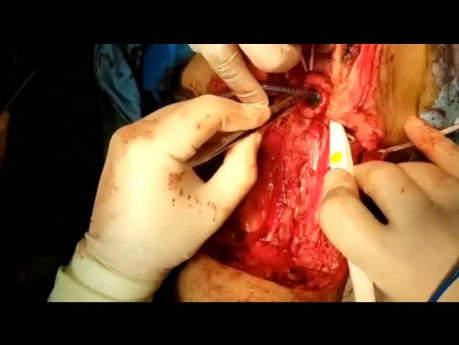 Exploración extensiva simultánea de cuello y mediastino por afectación tumoral invasiva