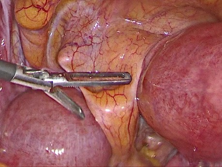 Histerectomía total laparoscópica debido al útero bicorne