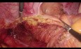Resección interesfinteriana laparoscópica para el cáncer intraanal: procedimiento completo