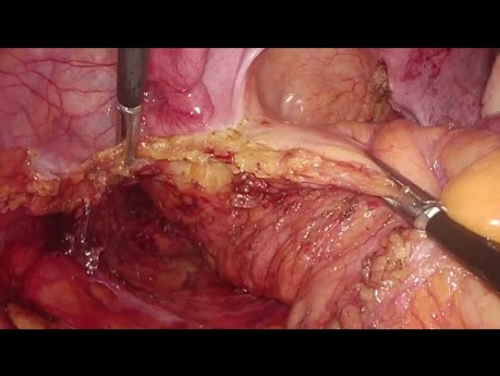 Resección interesfinteriana laparoscópica para el cáncer intraanal: procedimiento completo