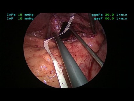 Tutorial de la aplicación de fundoplicatura geométrica; Capítulo 05 - Cierre del hiato diafragmático