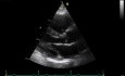 Ecocardiografía tridimensional en tiempo real: vista paraesternal en eje largo de la válvula mitral, vídeo n.º 1