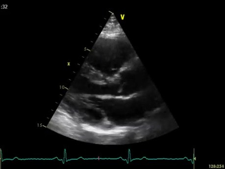 Ecocardiografía tridimensional en tiempo real: vista paraesternal en eje largo de la válvula mitral, vídeo n.º 1
