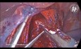 Preservación de la rama hepática del nervio vago anterior en la miotomía de Heller y fundoplicatura Dor para la acalasia