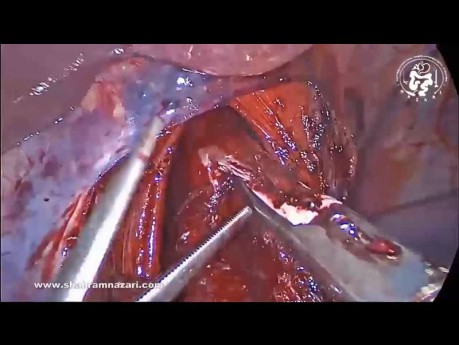 Preservación de la rama hepática del nervio vago anterior en la miotomía de Heller y fundoplicatura Dor para la acalasia