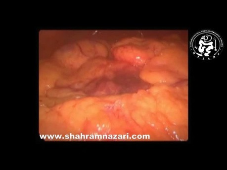 Vista laparoscópica: pancreatitis aguda edematosa