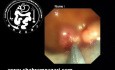 Cierre con clip: resección endoscópica de la mucosa (REM) del pólipo de colon por partes