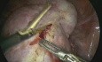 Escisión bilateral de un quiste dermoide de gran tamaño con preservación de ambos ovarios realizada con el uso de laparoscopia